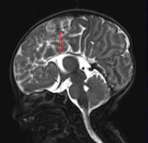Описание МРТ головного мозга